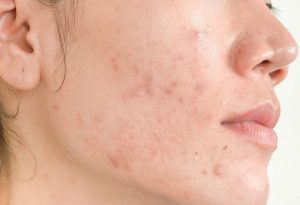 Remedio natural y saludable contra el acné